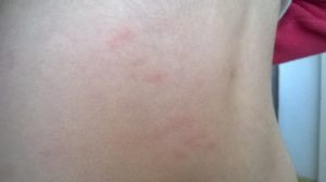 Красные пятна похожие на крапивницу