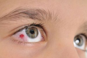 Кровавое пятно на глазе, когда снимала контактные линзы