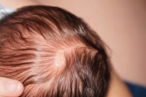 Мелкие коричневые образования на голове у ребёнка