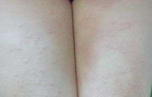 Красные прыщики на ляжках
