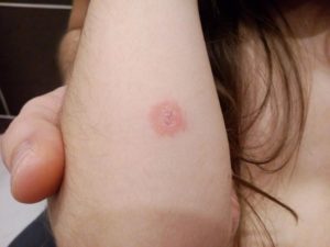 Красные пятна на коже с корочкой