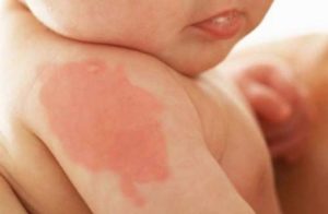 Красное пятно у мальчика 6 мес