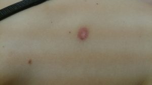 Красное пятно после удаления родинки