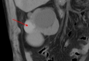Киста в почке и анализы
