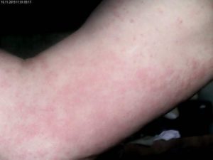 Красная сыпь на ноге