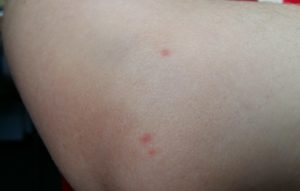 Красные пятна и боль