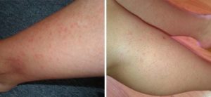 Красная сыпь на ноге