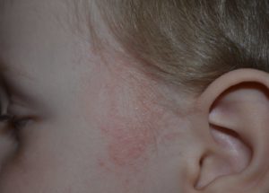 Красное шершавое пЯтно около уха, сыпь на щечках