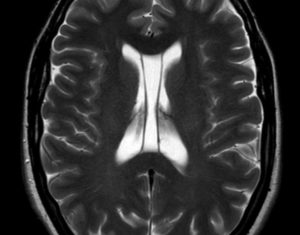 Кистозно расширенная полость Верге