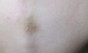 Круглое светло-голубое пятно на спине