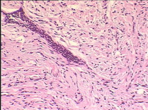 Инфильтративная дуктальная карценома