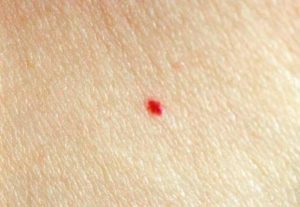Маленькие красные точки на теле