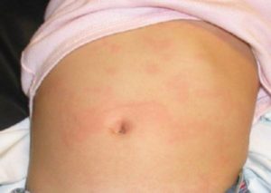 Красные пятна внизу живота у ребенка