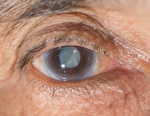 Болит глаз, мутное изображение картинки