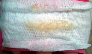 Коричневые выделения и зуд после менструации