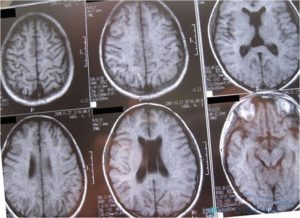 Кистозно расширенная полость Верге