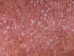 Инфекция на головке члена