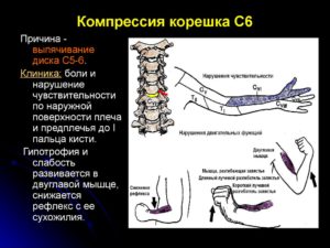Компрессия корешков