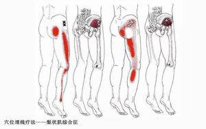 Боли в области таза слева отдающие в ногу