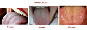 Хронический гастрит и белый налёт на языке