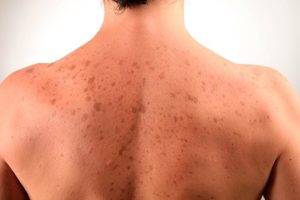 Пигментные пятна на спине