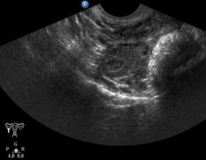 Киста яичника плода