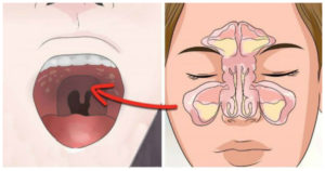 Изменение вкуса после гайморита