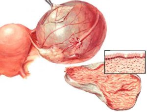 Киста яичника и рост волос на теле