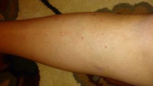 Красные прыщики на ноге