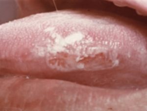 Лейкоплакия вульвы