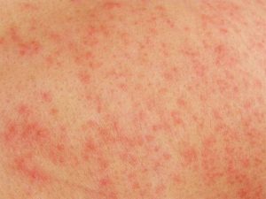 Красная сыпь после душа