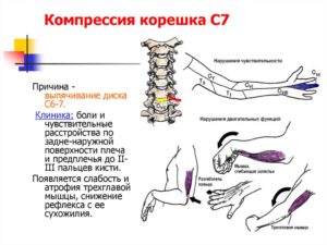 Компрессия корешков