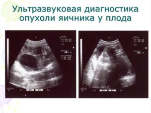 Киста яичника плода