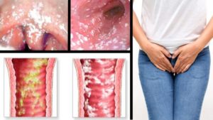 Как предотвратить молочницу после бассейна