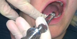 Болит и опухла десна после укола анестезии