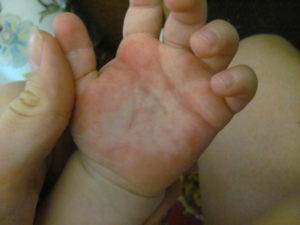 Красные ладошки, не проходящий зуд у ребенка