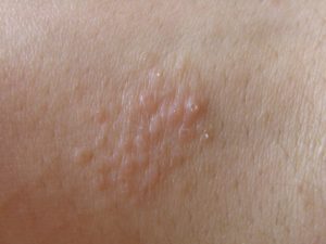 Мелкие бесцветные пупырышки на коже зимой их нет