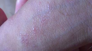 Красные волдыри на половом члене