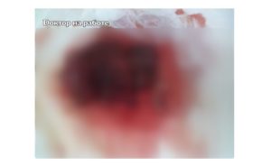 Кровотечение на 7 недели беременности