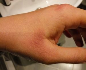 Красные пятна на коже (внешняя сторона ладони)