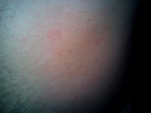 Красные пятна на торсе у мужчины