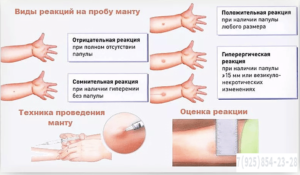 Манту при простуде