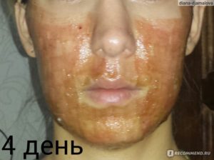 Корочки после лазерной шлифовки