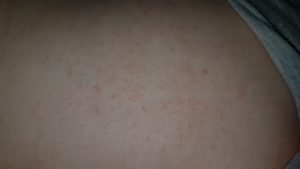 Мелкая сыпь на спине у двух детей и матери