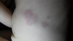Красные пятна похожие на крапивницу