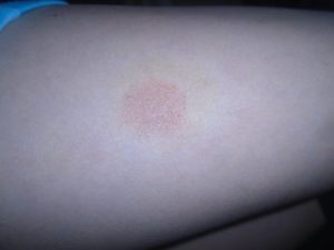 Красные, круглые пятна на нонах и руках, не чешутся