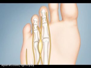 Болит палец безымянный на правой ноге при ходьбе, обувь свободная