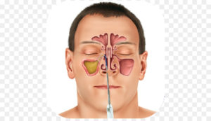 Болит пазуха носа после операции
