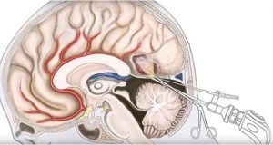 Киста головного мозга
