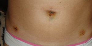 Болит послеоперационный шов